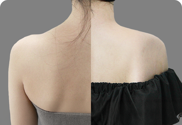 Shoulder Narrowing before and after