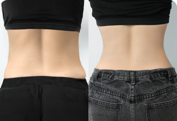 Pelvic Plasty before and after